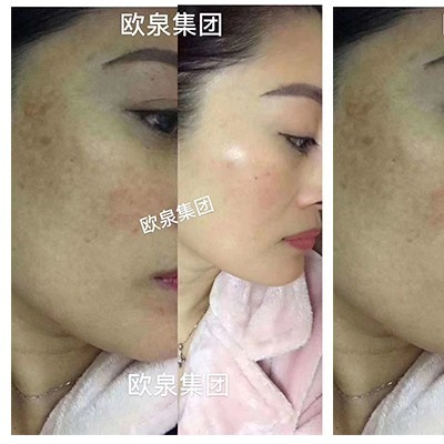 理性認(rèn)識(shí)和使用祛斑靚膚類化妝品